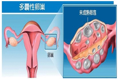 中西医如何看待多囊卵巢综合症(图1)